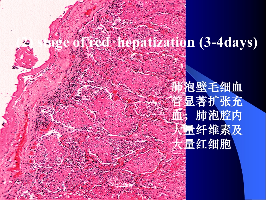 第七章 呼吸系统疾病（七年制）课件.ppt_第2页