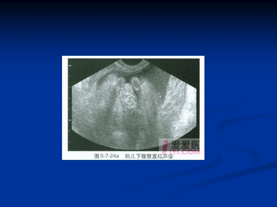 胎儿骨骼系统发育异常超声诊断系列课件.ppt_第3页