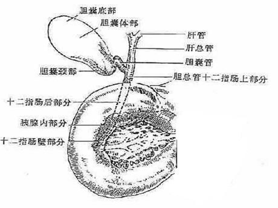 胆 系 结石和感染课件.ppt_第3页