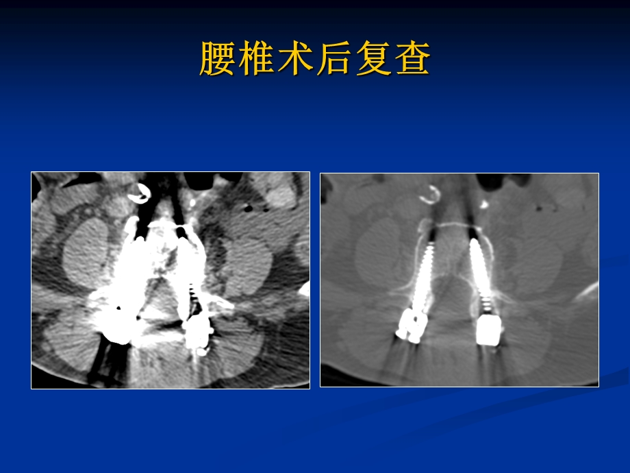 能谱CT减除骨科金属植入物课件.pptx_第2页