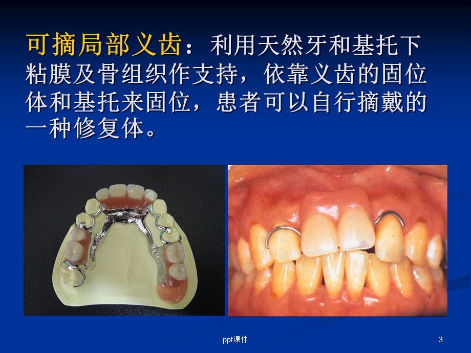 第三章 可摘局部义齿工艺技术课件.ppt_第3页