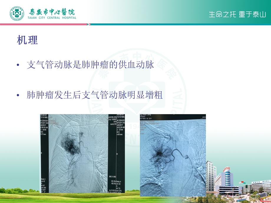 肺癌支气管动脉化疗栓塞术 教学查房课件.ppt_第3页