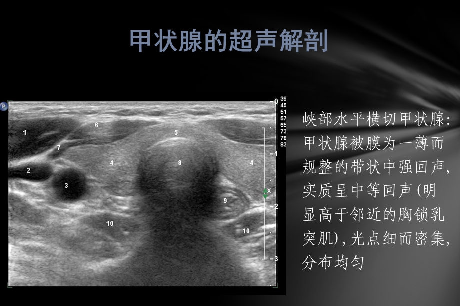 甲状腺疾病的超声检查课件.pptx_第3页