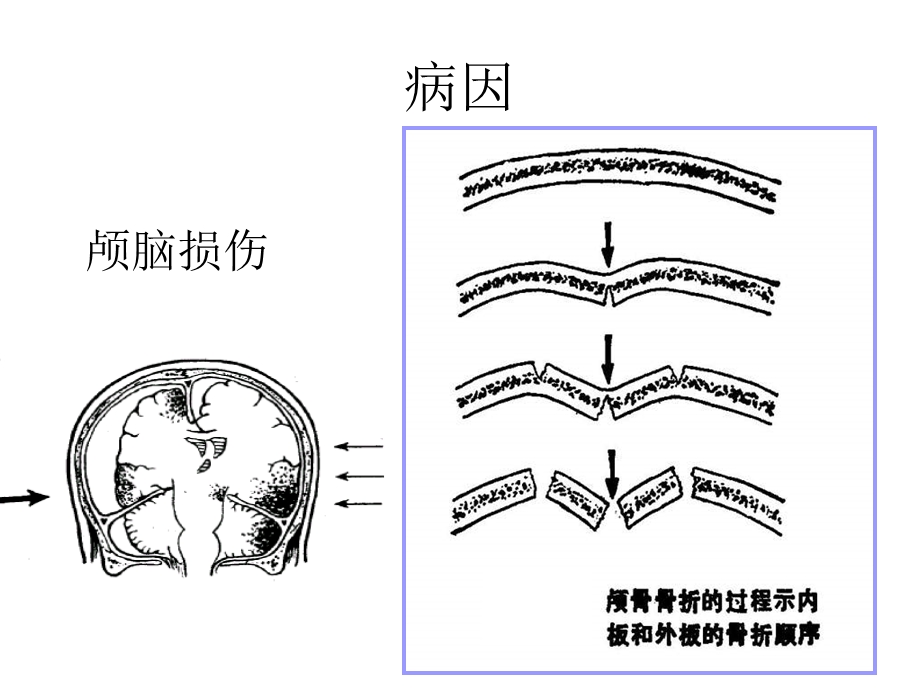 硬膜外血肿课件.ppt_第2页