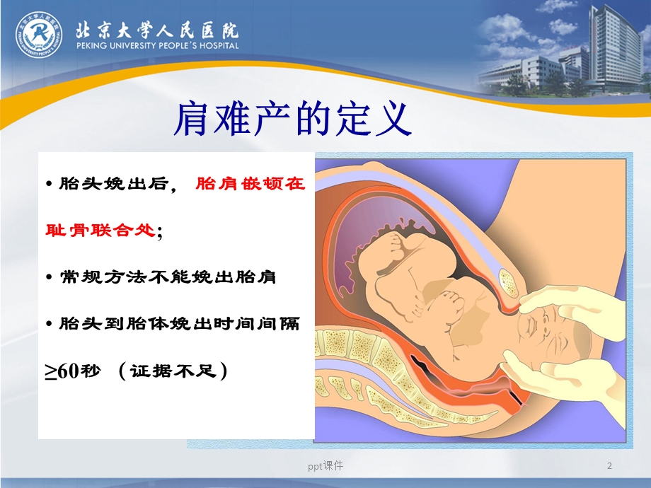 肩难产的识别和处理课件.ppt_第2页