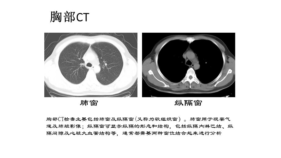 胸部CT病理影像课件.pptx_第3页