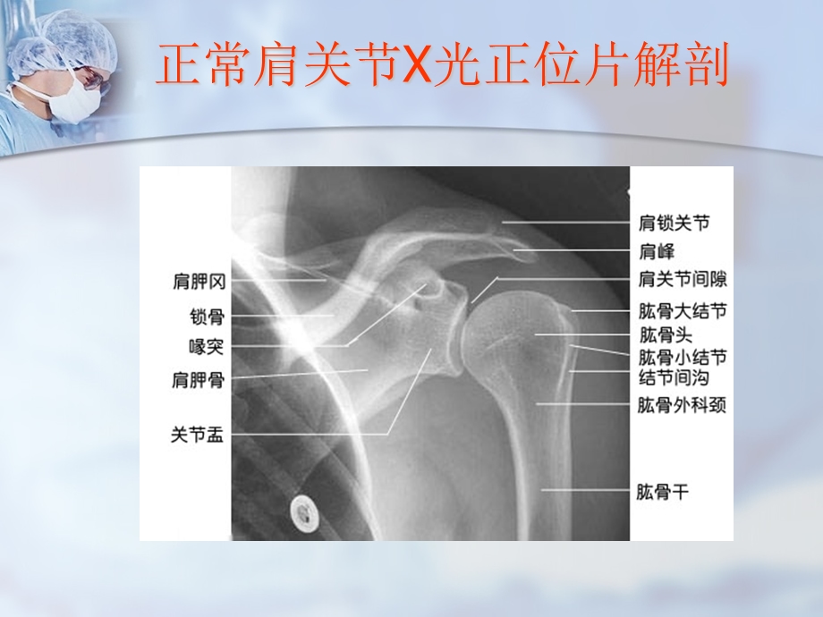 肱骨近端骨折课件.ppt_第2页