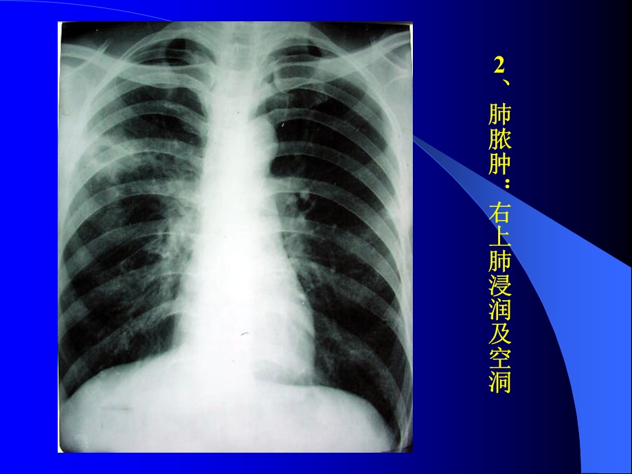 胸部X片、CT读片课件.ppt_第3页