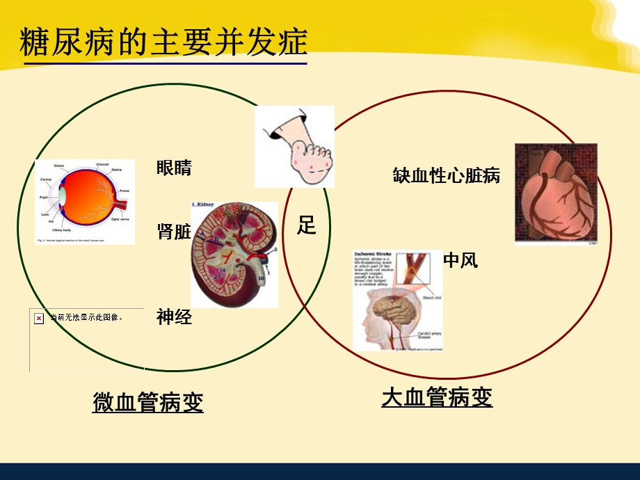 糖尿病肾病的饮食健康教育课件.ppt_第2页