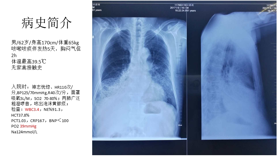 禽流感规范化治疗课件.pptx_第2页