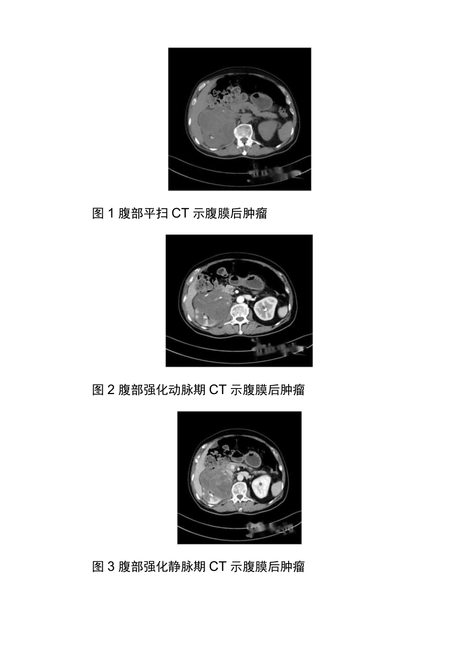 外科医师晋升副主任（主任）医师高级职称专题报告病例分析报告4篇.docx_第3页