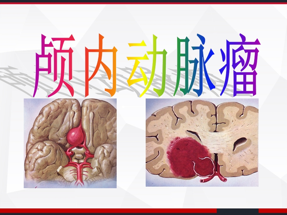 颅内动脉瘤介入术后的护理课件.ppt_第1页