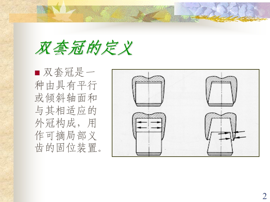 双套冠义齿的临床操作课件.ppt_第2页