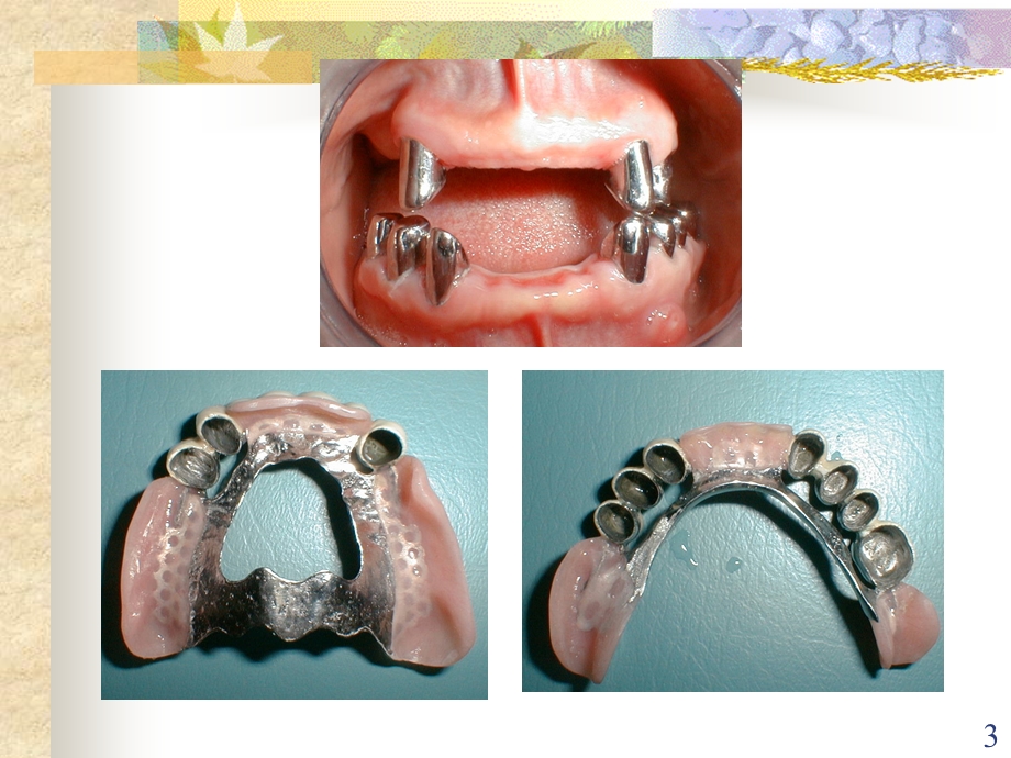 双套冠义齿的临床操作课件.ppt_第3页