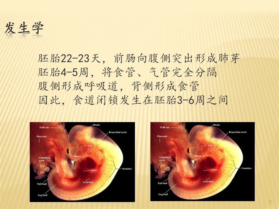 先天性食管闭锁的护理课件.ppt_第3页