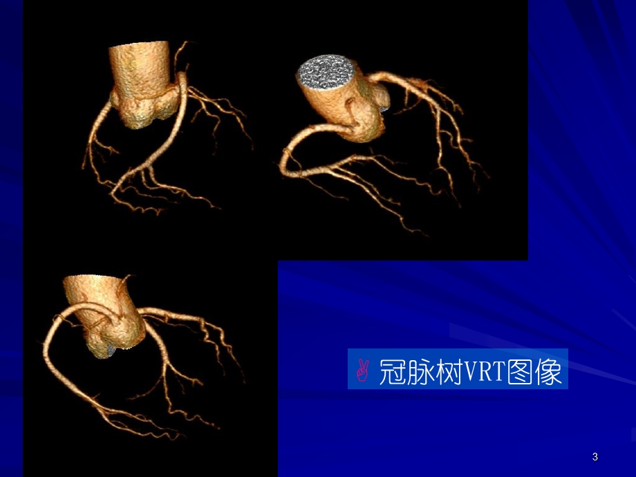 双源CT及其临床应用课件ppt.ppt_第3页