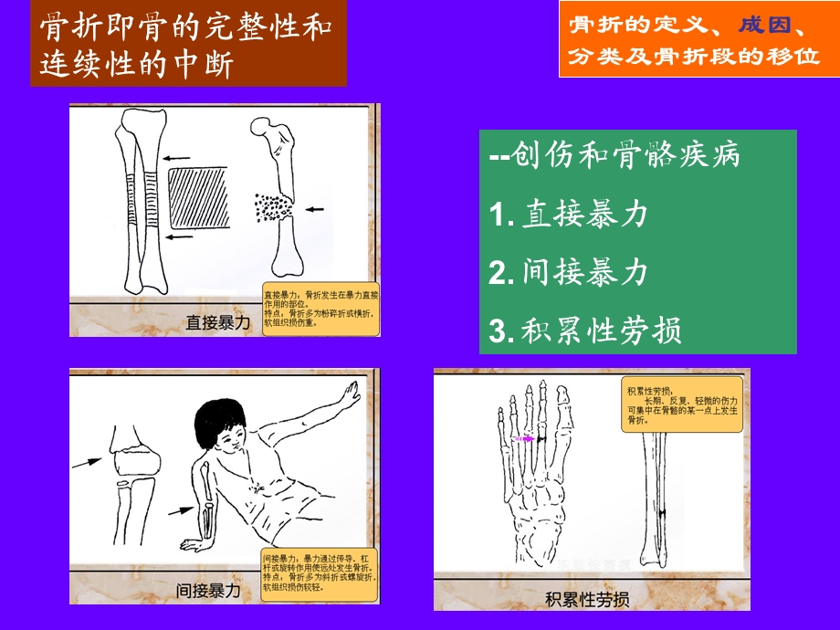 骨折、愈合、康复课件.ppt_第1页