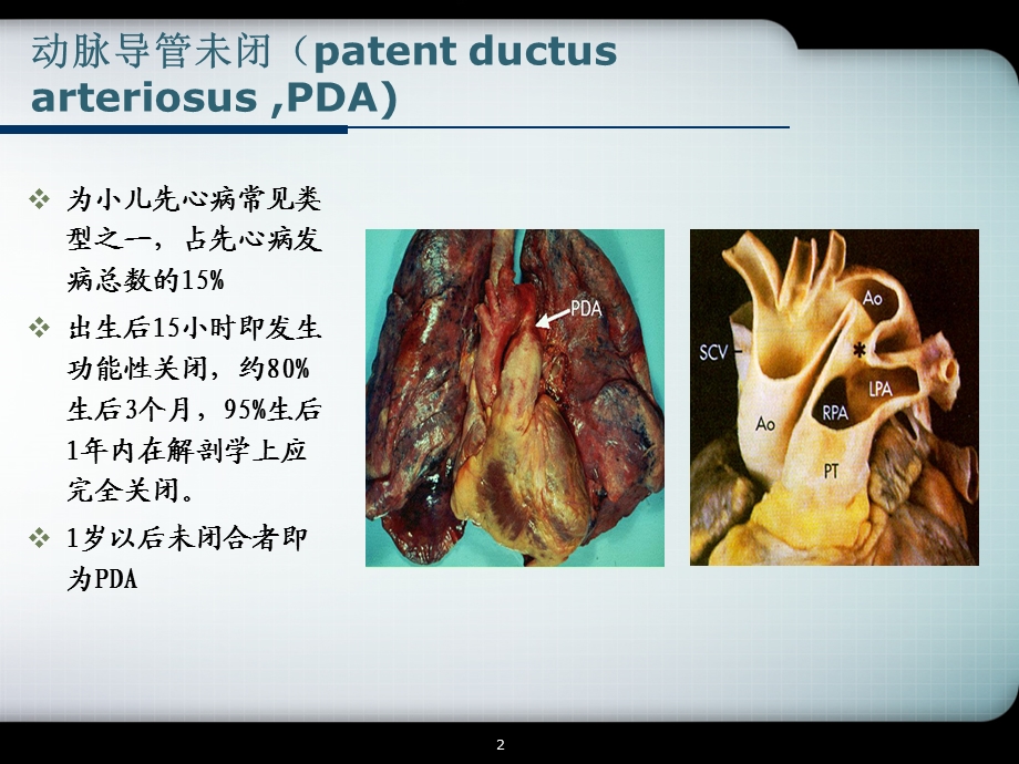 动脉导管未闭课件.pptx_第2页