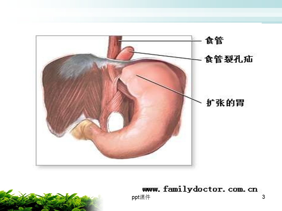 食道裂孔疝护理课件.ppt_第3页