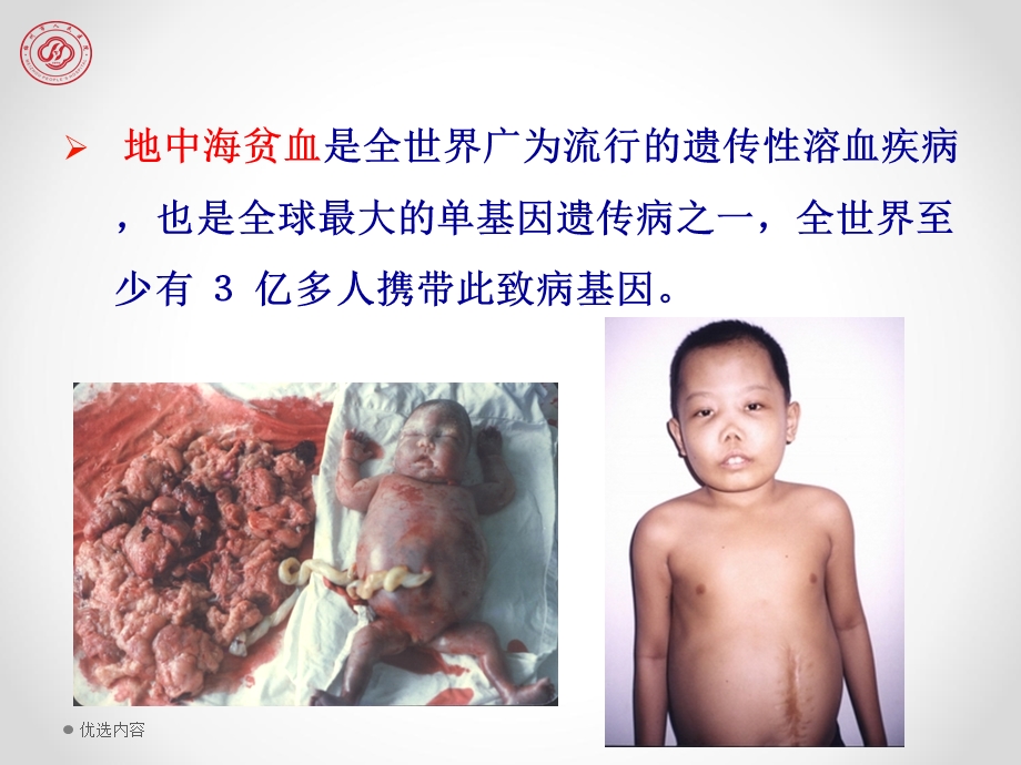 地中海贫血的现状与讨论(特选参考)课件.ppt_第3页