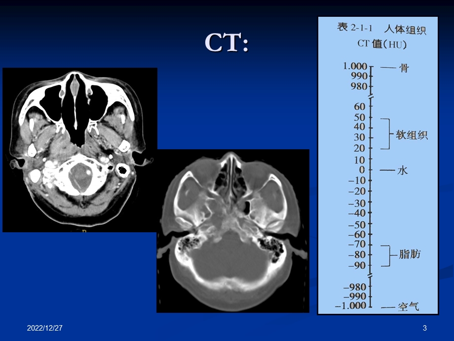 鼻咽癌的CT与MRI诊断课件.ppt_第3页
