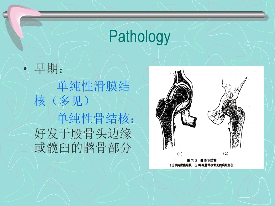 髋膝关节结核课件.ppt_第3页