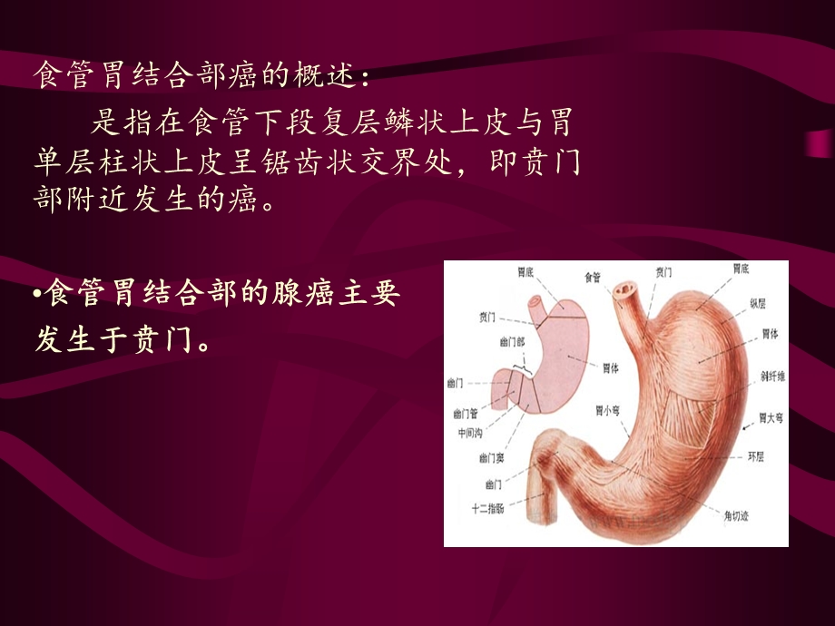 食道胃底结合部癌课件.ppt_第2页