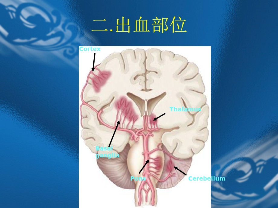 高血压性脑出血课内学习课件.ppt_第3页