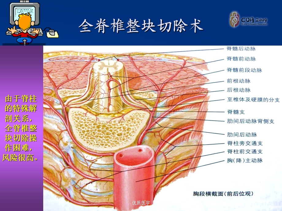 全脊柱整块切除技术治疗侵袭性脊柱血管瘤(清晰详实课件.ppt_第3页