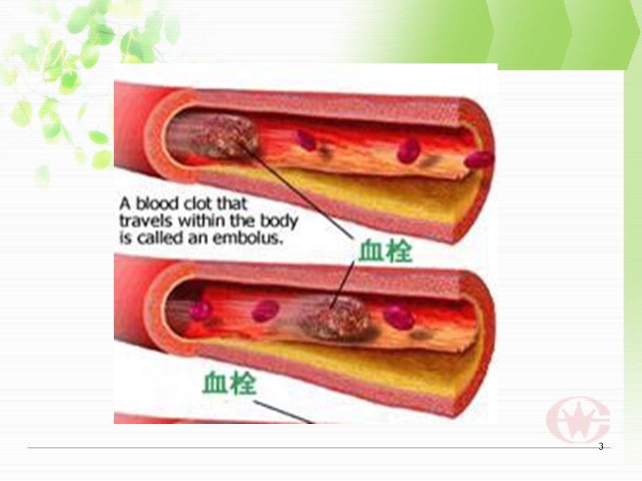 双下肢深静脉血栓形成课件.ppt_第3页