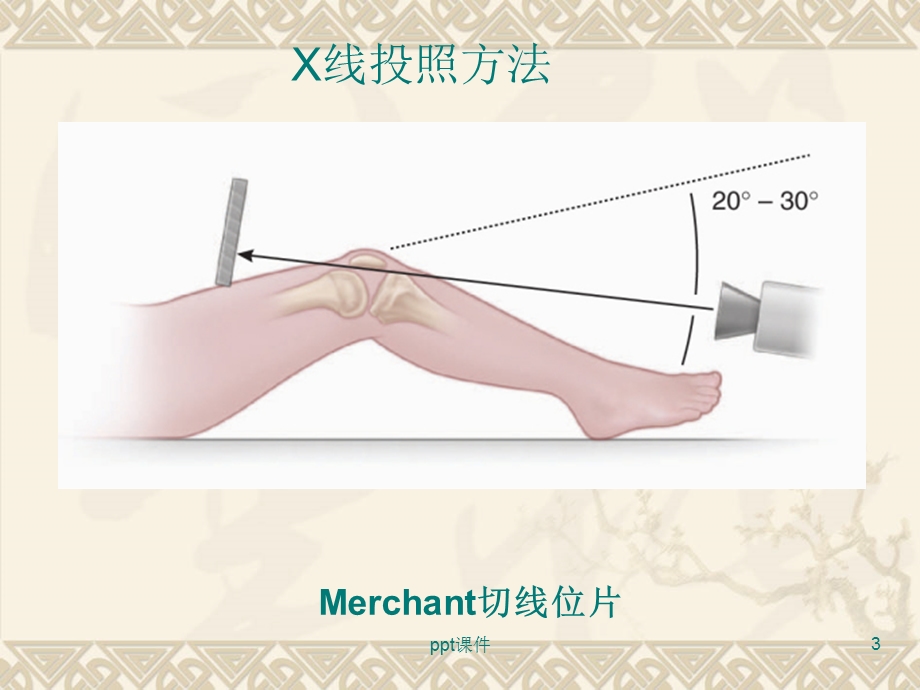 髌骨脱位精讲版课件.ppt_第3页