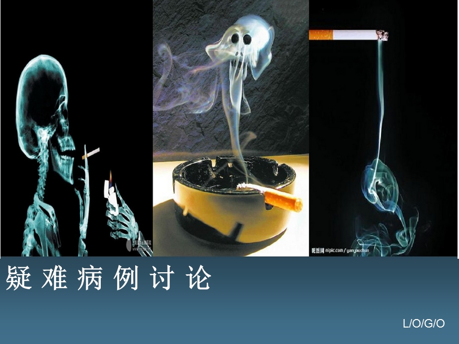 喉癌疑难病例讨论课件.ppt_第1页