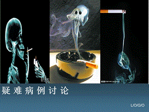 喉癌疑难病例讨论课件.ppt