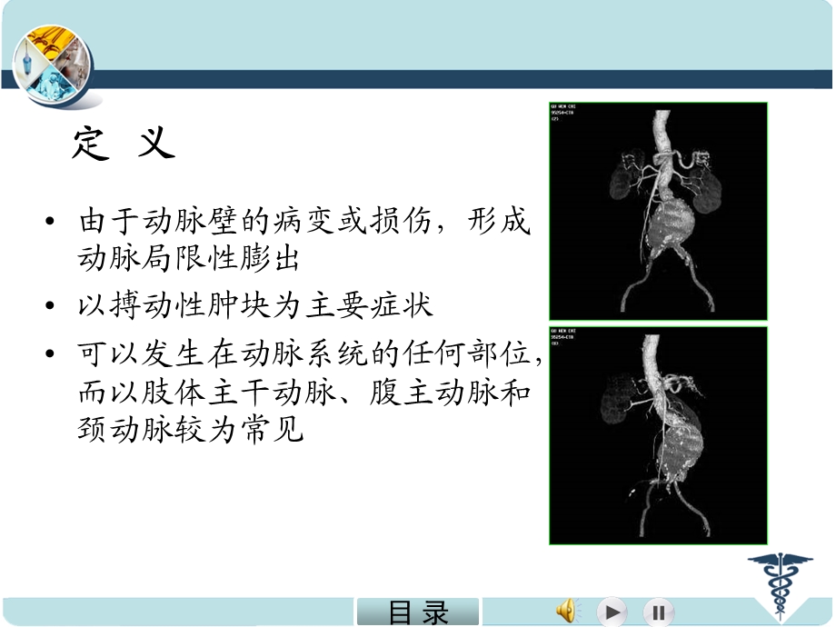 动脉瘤含周围动脉瘤荟萃知识课件.ppt_第2页