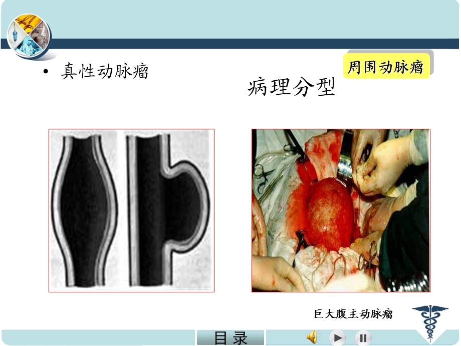 动脉瘤含周围动脉瘤荟萃知识课件.ppt_第3页