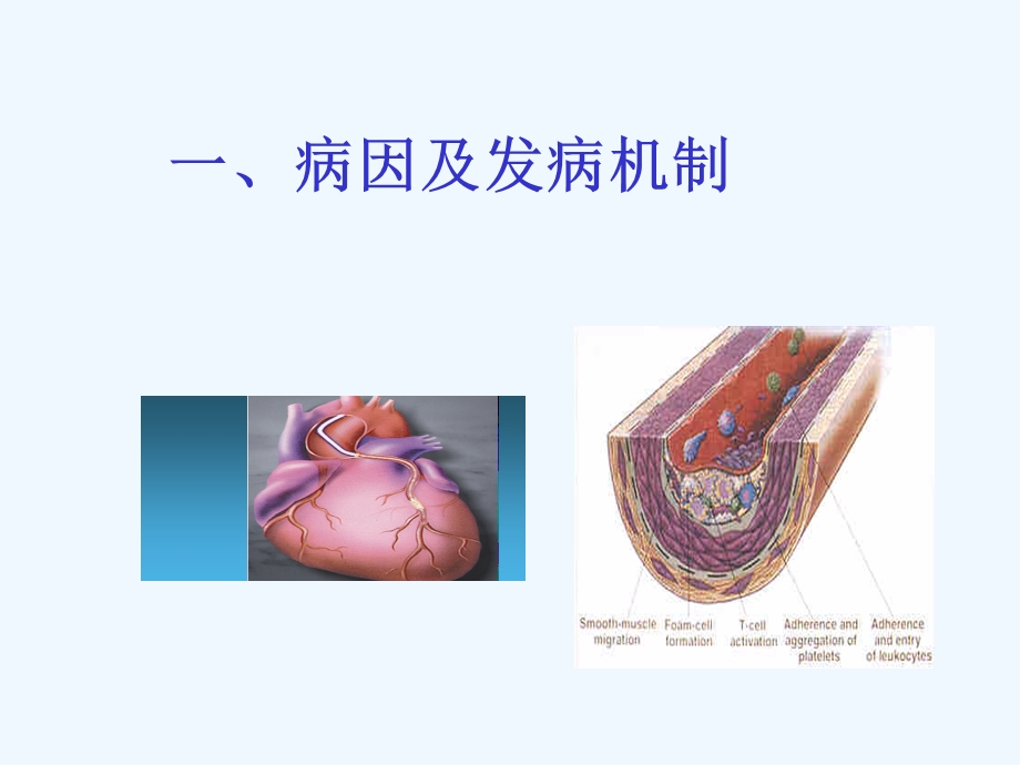 动脉粥样硬化和冠状动脉动脉粥样硬化性心脏病课件.ppt_第3页