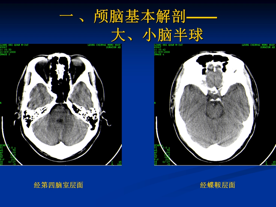 颅脑基本CT征象及颅脑外伤性疾病CT诊断课件.ppt_第2页