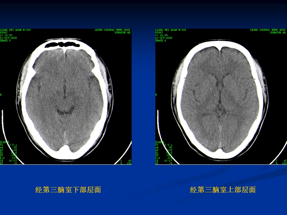 颅脑基本CT征象及颅脑外伤性疾病CT诊断课件.ppt_第3页