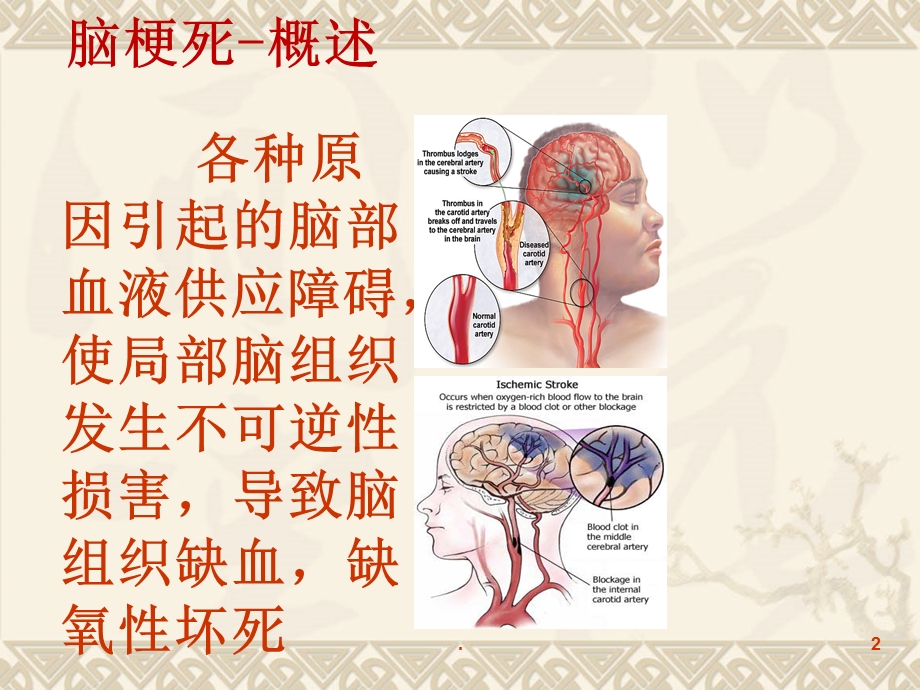 最经典的脑梗死临床表现及治疗课件.ppt_第2页