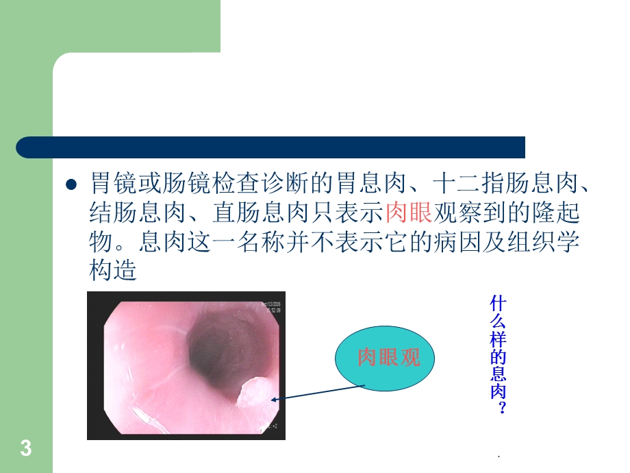 消化道息肉课件.ppt_第3页