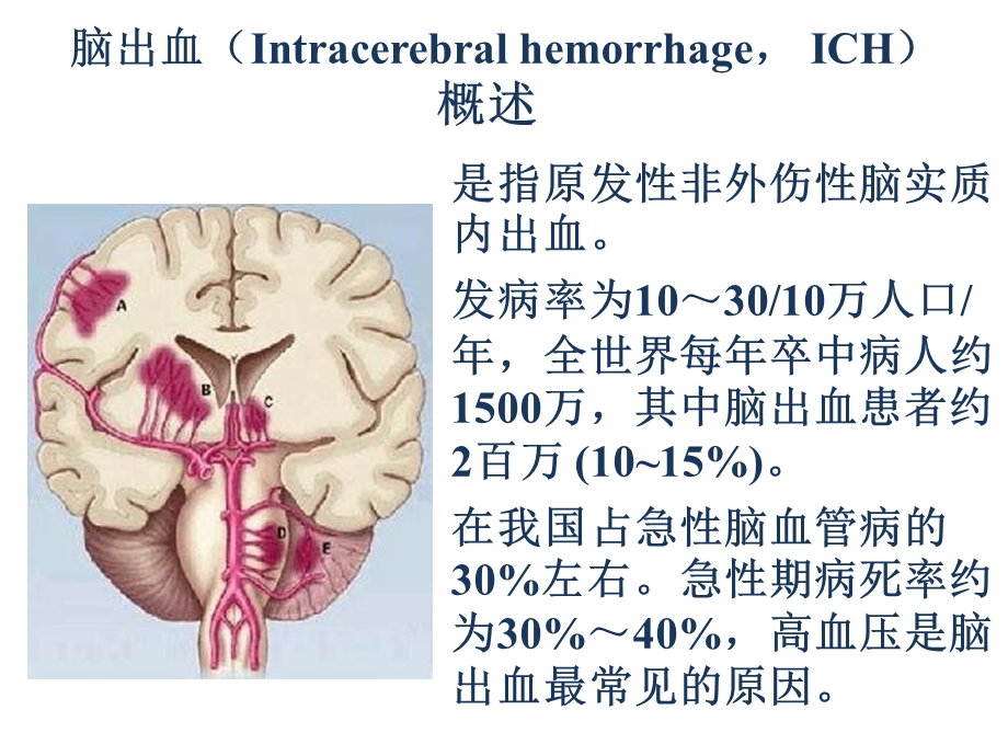 脑出血规范化治疗课件.ppt_第3页