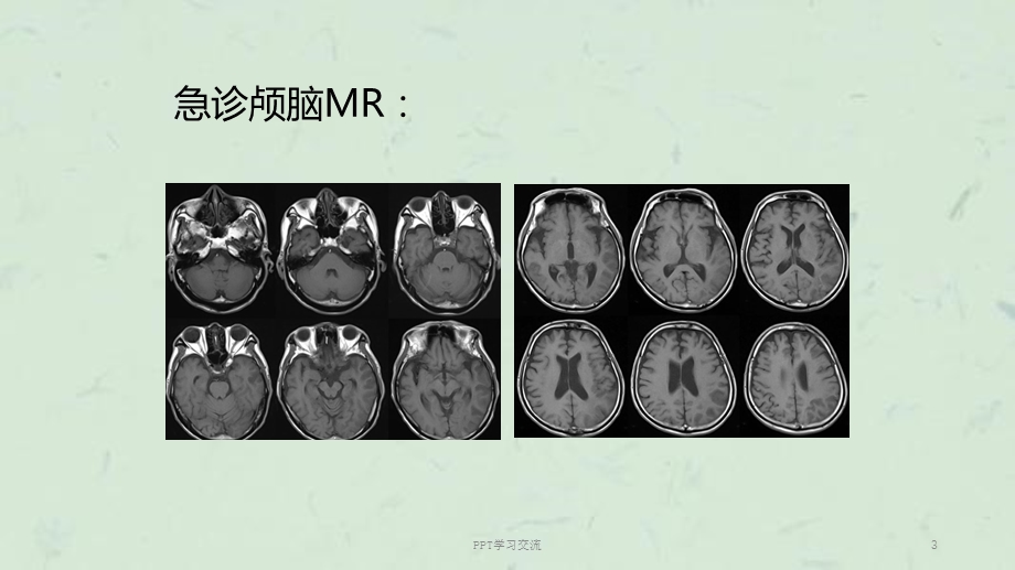 大面积脑梗死的诊断及治疗ppt课件.ppt_第3页