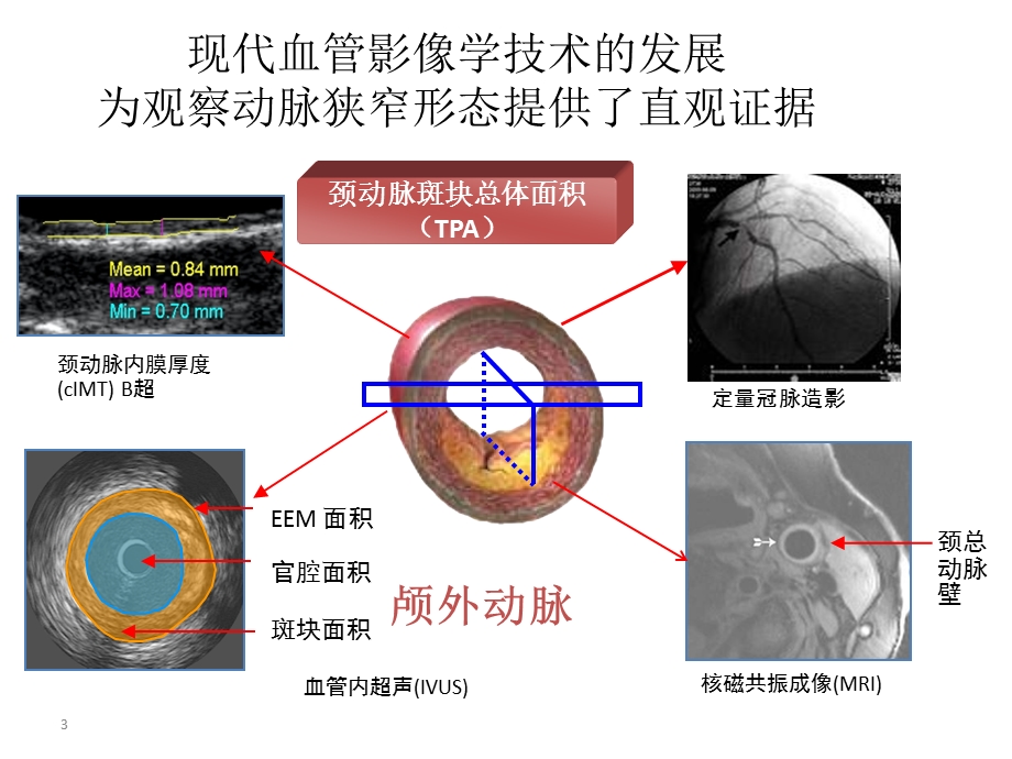 症状性颅内动脉狭窄患者的最佳药物治疗课件.ppt_第3页