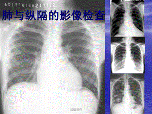 教你如何看肺部CT(培训调研)课件.ppt