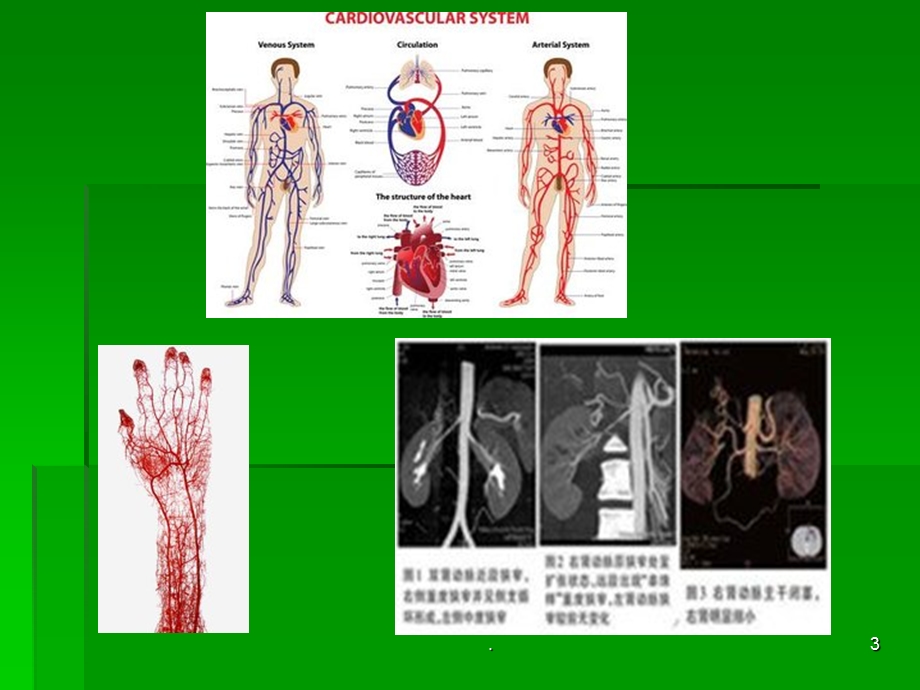 血管病变及防治课件.ppt_第3页