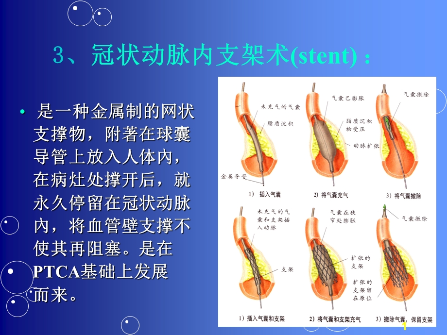 心血管病介入护理课件.ppt_第1页