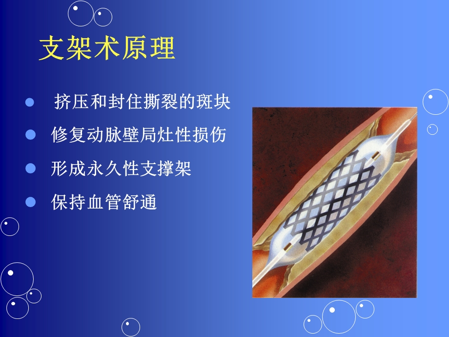 心血管病介入护理课件.ppt_第3页