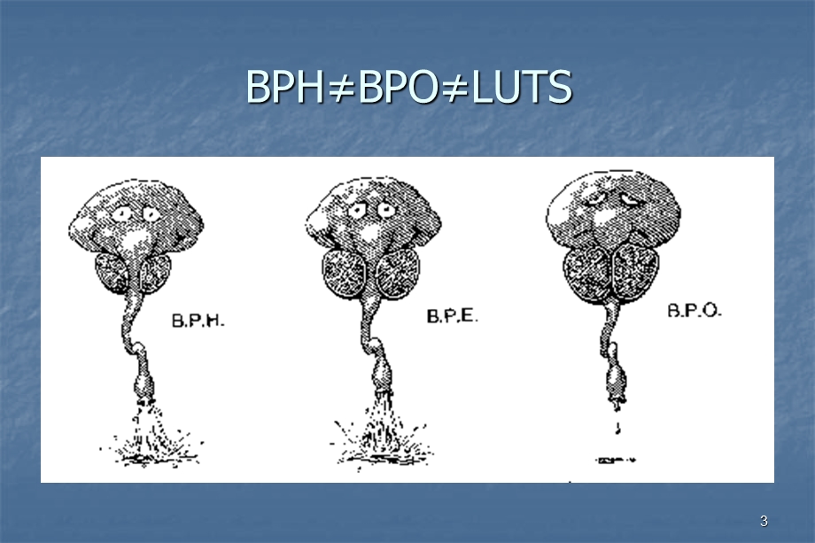 良性前列腺增生的尿动力学检查课件.ppt_第3页