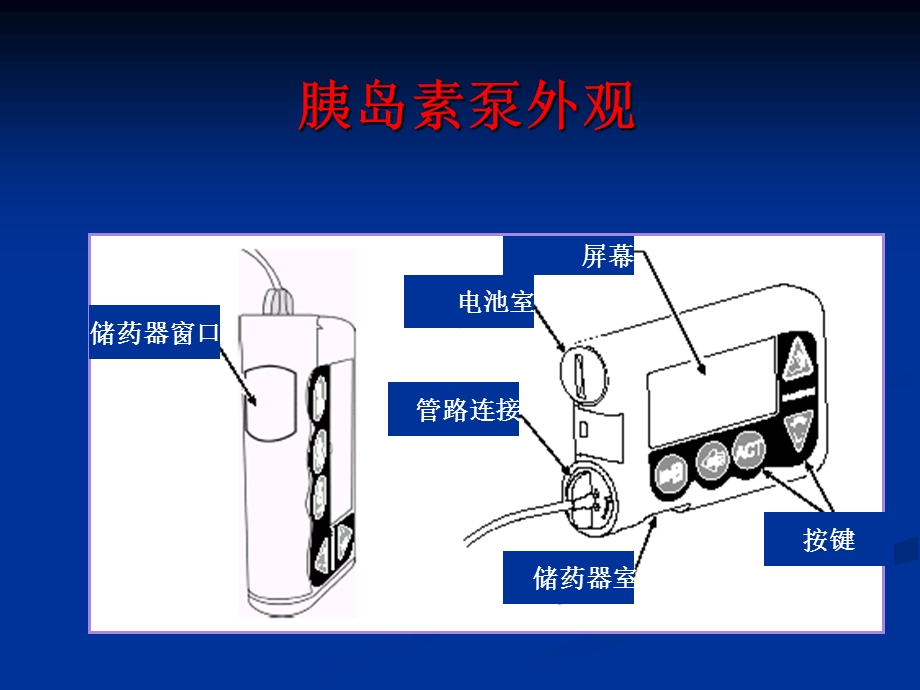 胰岛素泵治疗介绍课件.ppt_第3页