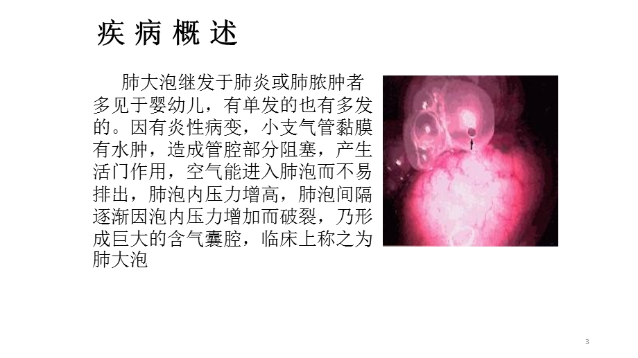 胸腔镜下肺大泡切除术课件.pptx_第3页